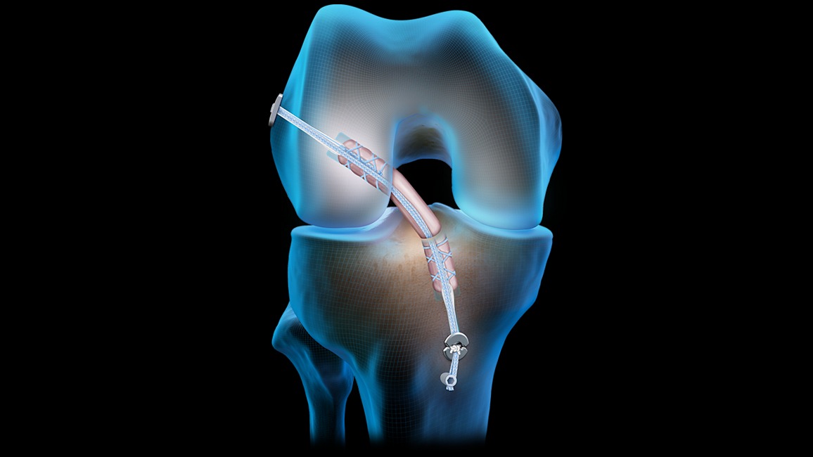 WP1-00559-EN_Quad_Tendon_Graft_A